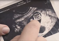 Joanna z Limanowej: moja ciąża pozamaciczna w bliźnie po cesarskim cięciu - zdjęcie główne