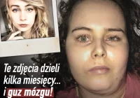 "Justyna nie poddaje się i walczy z guzem, który to w okrutny to sposób przypomniał o sobie" - zdjęcie główne