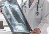 Pulmonolog: liczba przypadków raka płuc w Polsce nie maleje; winne są nowe wyroby nikotynowe - zdjęcie główne