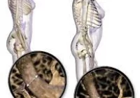 Bezpłatne badania w kierunku osteoporozy - zdjęcie główne