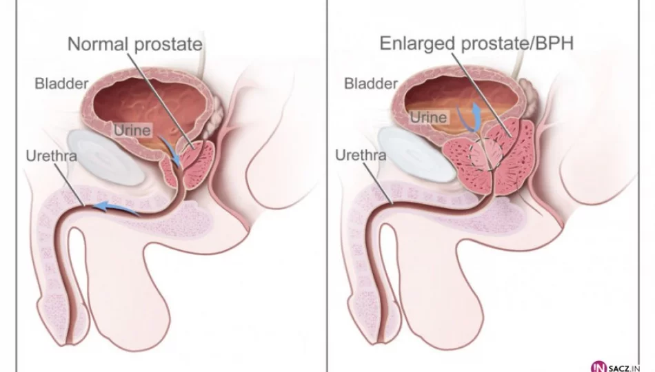 Prostata wymaga nadzoru, trzy osoby mogą uniknąć raka - zdjęcie 1