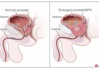 Prostata wymaga nadzoru, trzy osoby mogą uniknąć raka - zdjęcie główne