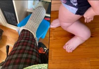 "Nawet nie wiecie, jaka to radość widzieć prostą nogę po tylu latach ogromnej deformacji" - zdjęcie główne