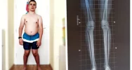 Tylko operacja nóg może uratować 19-letniego Adriana przed wózkiem - zdjęcie 2
