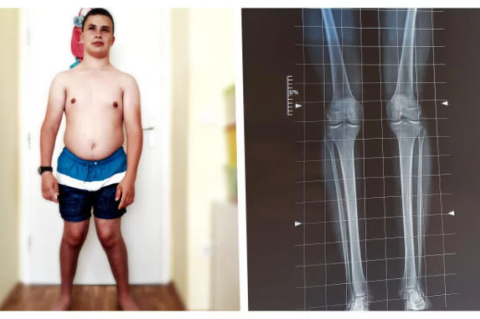 Tylko operacja nóg może uratować 19-letniego Adriana przed wózkiem - zdjęcie 2