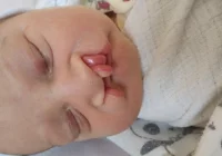 Rozalka przyszła na świat z poważną wadą. W pierwszym roku życia musi przejść trzy operacje - zdjęcie główne