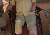 Noga nie odrosła, a wg lekarzy stopień zmalał - zdjęcie główne