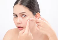 3 częste przyczyny trądziku - co wywołuje trądzik i jak go zwalczysz najprostszymi kosmetykami? - zdjęcie główne