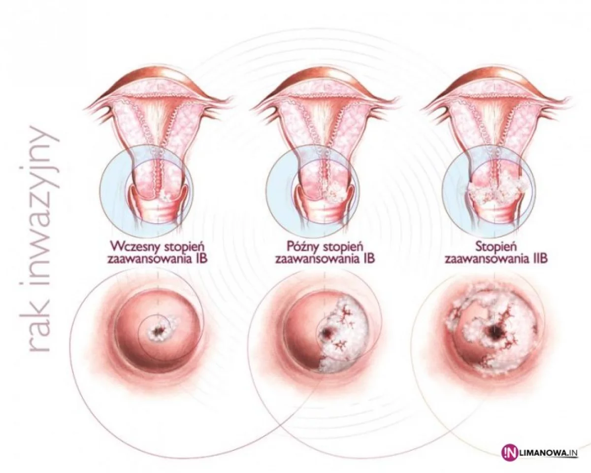 Polki nie muszą umierać na raka szyjki macicy