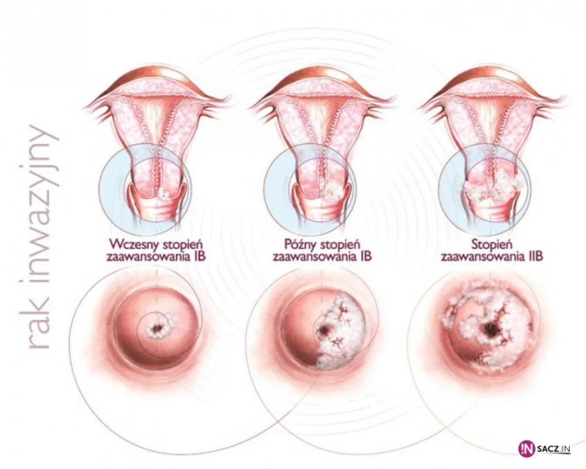 Polki nie muszą umierać na raka szyjki macicy