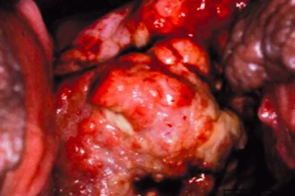 Polki nie muszą umierać na raka szyjki macicy - zdjęcie 2