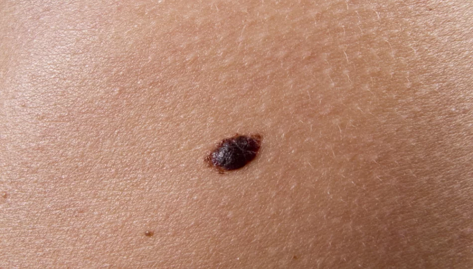 Rak skóry błędnie kojarzony jest głównie z czerniakiem - zdjęcie 1