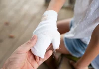 Co robić po oparzeniu? Prawidłowe postępowanie - zdjęcie główne