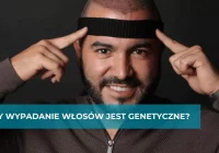 Czy wypadanie włosów jest genetyczne? - zdjęcie główne